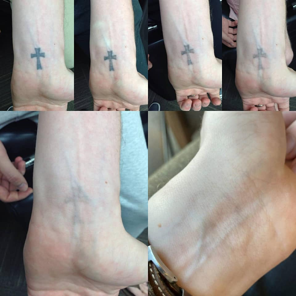 Before And After Tattoo Removal Woman Before And After Laser Tattoo Before And After Tattoo Removal Woman Before And After Laser Tattoo