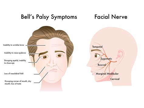 How To Manage Bell's Palsy Bradycardia: A Practical Guide