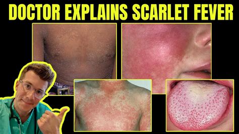 Doctor Explains Scarlet Fever Group A Streptococcal Disease Causes Symptoms Treatment Youtube Doctor Explains Scarlet Fever Group A Streptococcal Disease Causes Symptoms Treatment Youtube