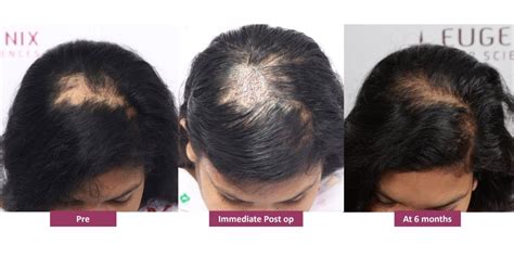 Everything You Need To Know About Hair Restoration For Women Eugenix Hair Sciences Pvt Ltd Everything You Need To Know About Hair Restoration For Women Eugenix Hair Sciences Pvt Ltd