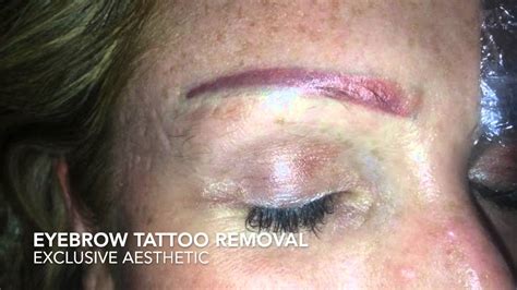 Eyebrow Tattoo Removal By Exclusive Aesthetic Youtube Eyebrow Tattoo Removal By Exclusive Aesthetic Youtube