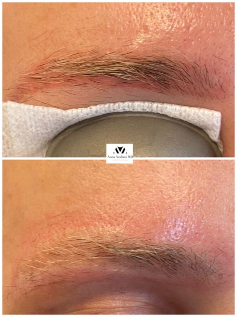 Gallery Tattoo Eyebrow Removal Anna Avaliani Md Cosmetic Amp Laser Gallery Tattoo Eyebrow Removal Anna Avaliani Md Cosmetic Amp Laser