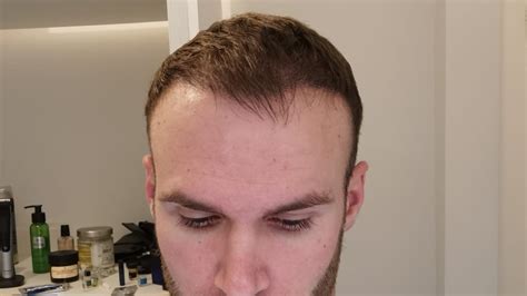 I Started Going Bald At 25 A Hair Transplant Changed My Life I Started Going Bald At 25 A Hair Transplant Changed My Life