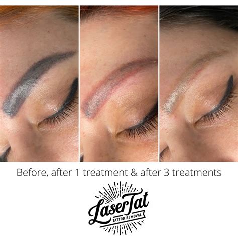 Lasertat Amp 39 S Guide To Cosmetic Eyebrow Tattoo Removal Lasertat Lasertat Amp 39 S Guide To Cosmetic Eyebrow Tattoo Removal Lasertat